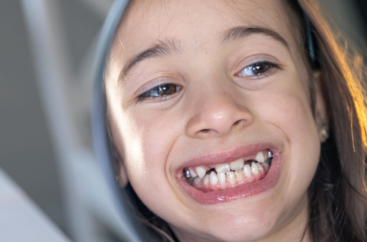 Diş Çapraşıklığı ve Çürük Riskleri: Ortodonti ile Önlenebilir mi? - Dr. Dt. Erman Canlı