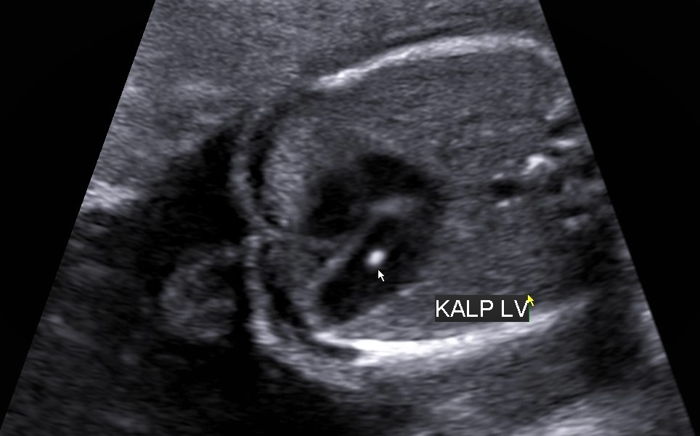 Fetal İntrakardiyak Ekojen Odak Nedir?