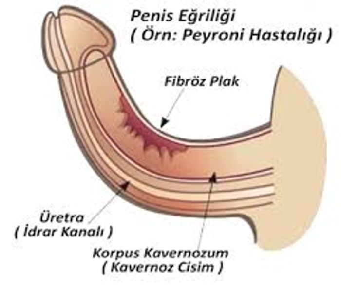 Penis Eğriliği
