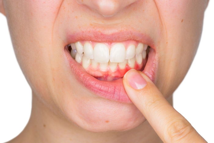 Periodontitis Nedir? Gingivitis Nedir?
